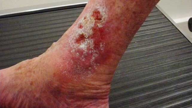 4705-Multiple_Venous_Ulcer-642x361-multiple_venous_ulcer-slide3 4705-Multiple_Venous_Ulcer-642x361-multiple_venous_ulcer-slide3
