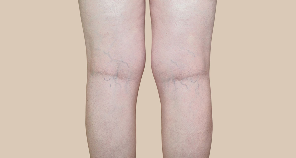 The Truth Behind Spider Veins that You Need to Know — Skin MD -  Dermatologist in Ortigas, Pasig