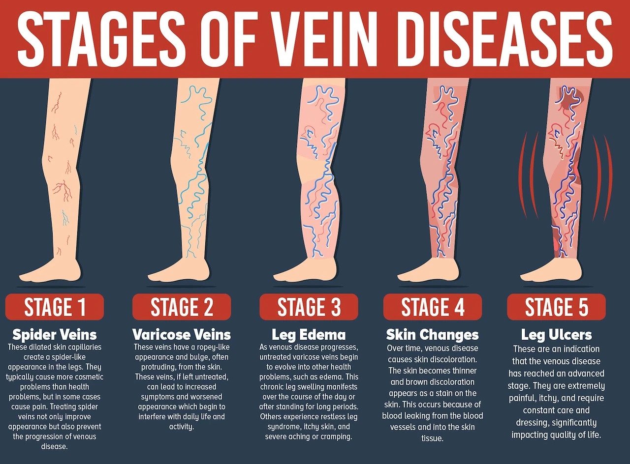 What are the stages of chronic venous insufficiency?