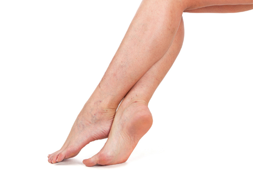 Understanding Varicose Veins in the Feet