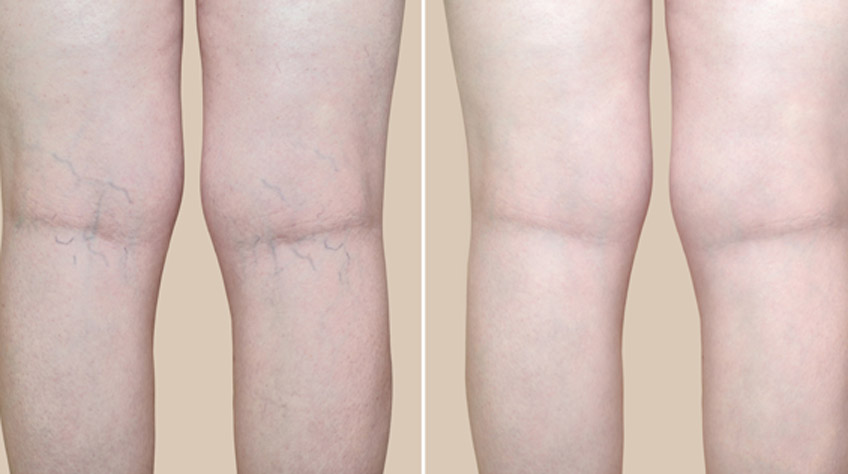 Before-and-after-photos-of-varicose-vein-treatment-in-Las-Vegas