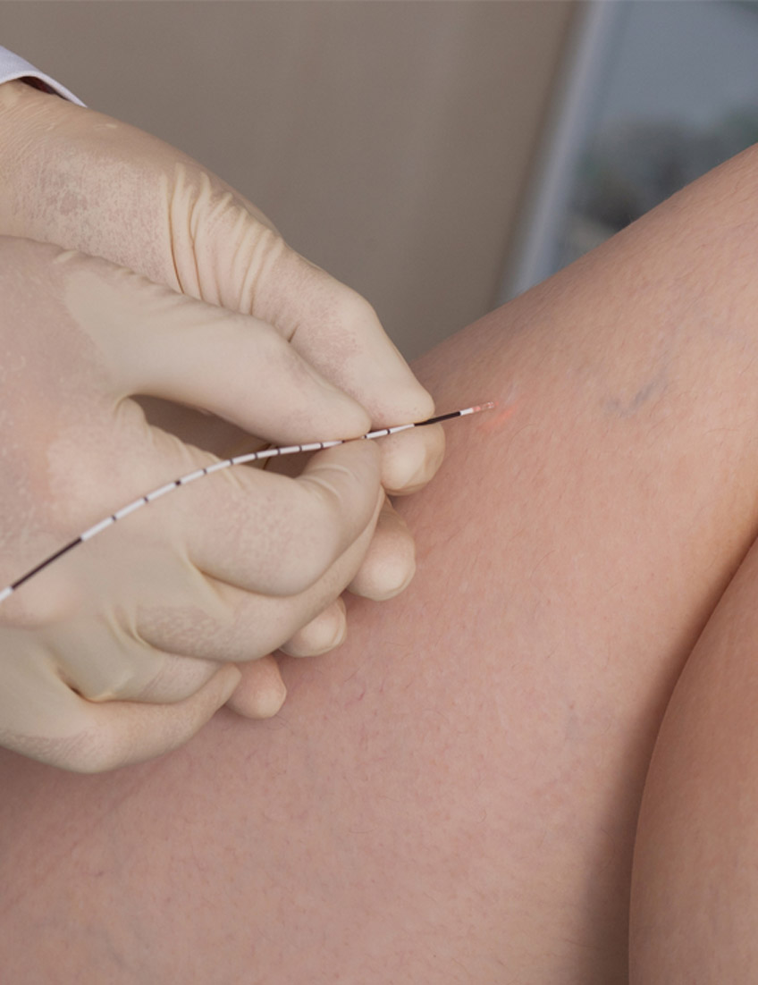 Varicose-veins-doctor-in-Las-Vegas-providing-treatment