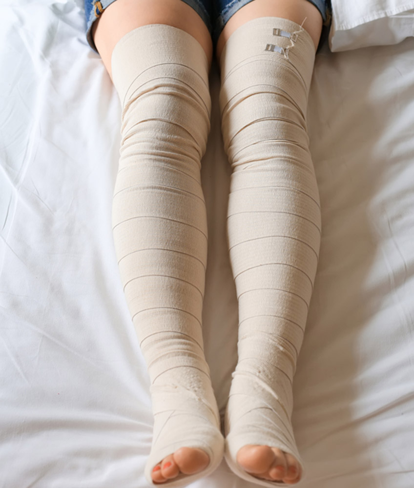 Woman-wearing-elastic-leg-bandage-to-prevent-varicose-veins-after-laser-treatment-for-varicose-veins-in-Las-Vegas
